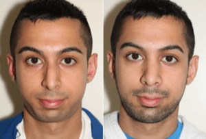 Dr. Denton chin implant before and after photo of a male patient