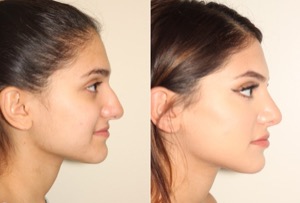 Dr. Denton Rhinoplasty before and after photo of a female patient