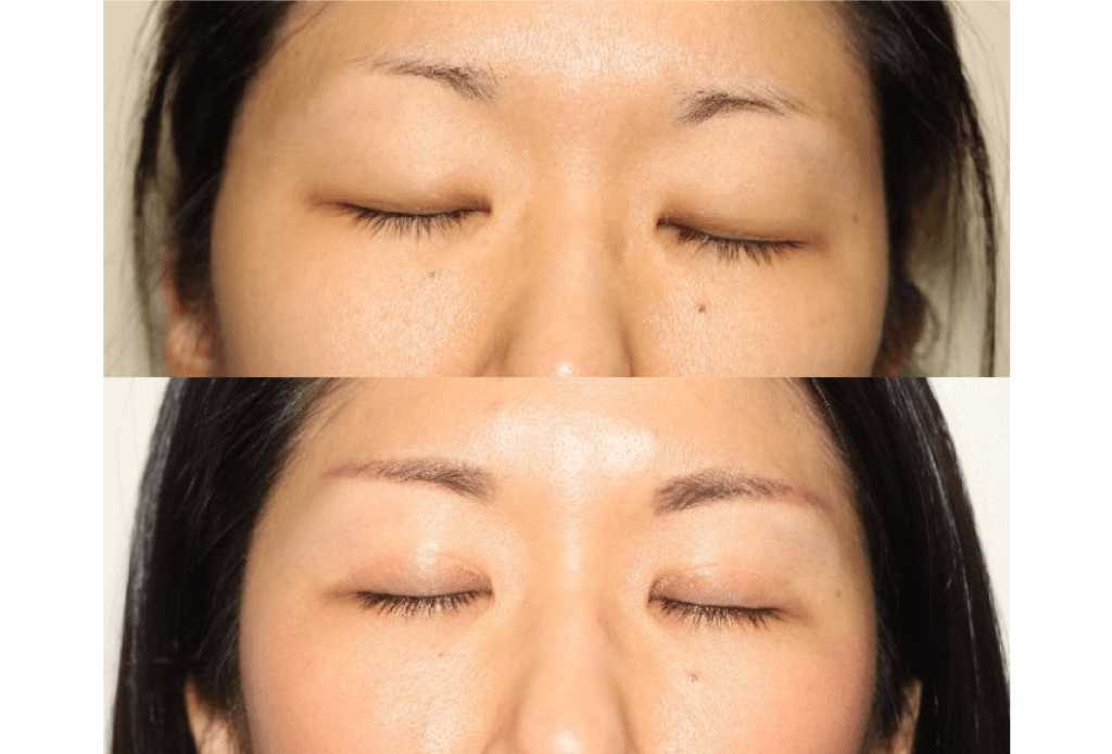 Dr. Denton Asian blepharoplasty before and after photo of a female patient