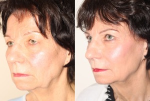 Dr. Denton blepharoplasty before and after photo of a female patient