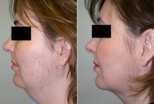 Dr. Denton liposuction before and after photo of a female patient