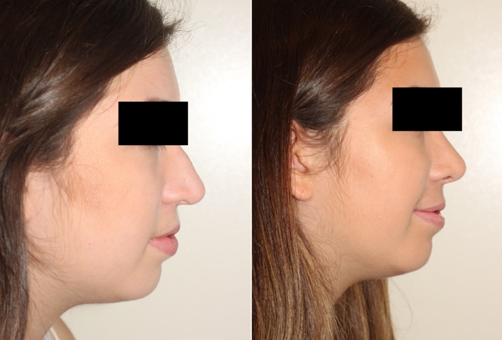 Dr. Denton Rhinoplasty before and after photo of a female patient