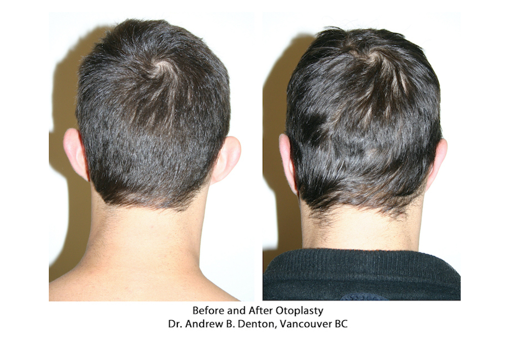 Dr. Denton Otoplasty before and after - ear lobe repair