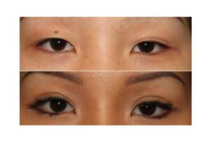 Before and After of a young woman who has undergone Asian Eyelid Surgery