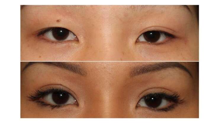 What Is Asian Eyelid Surgery?