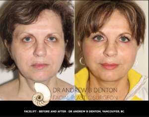 Before and After of a middle age female who underwent a facelift procedure at Dr Denton's Vancouver Clinic
