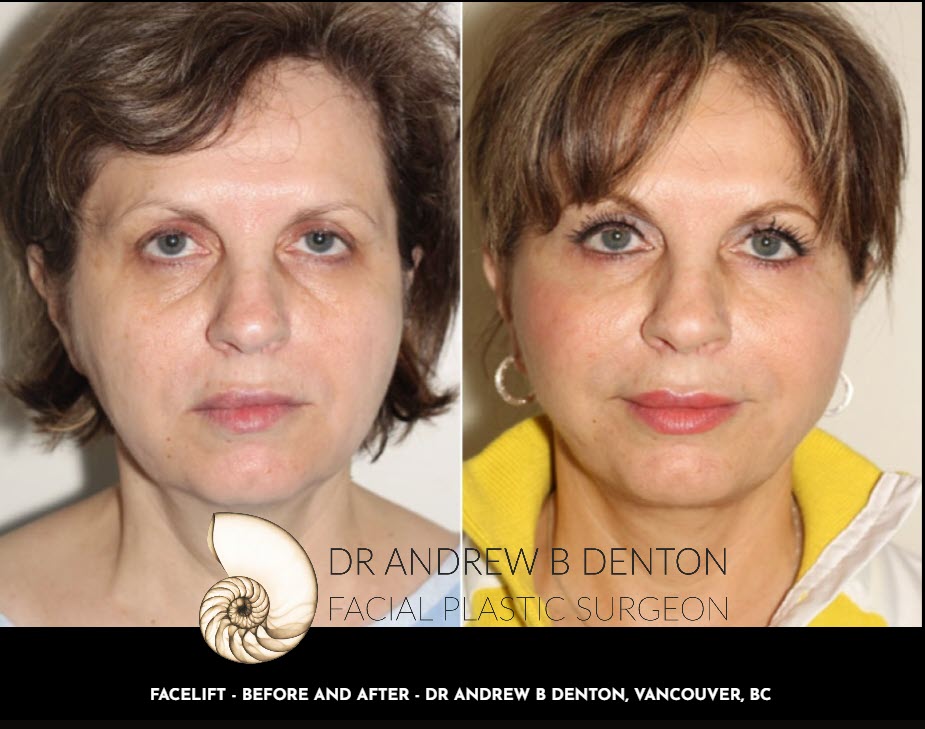 Before and After of a middle age female who underwent a facelift procedure at Dr Denton's Vancouver Clinic