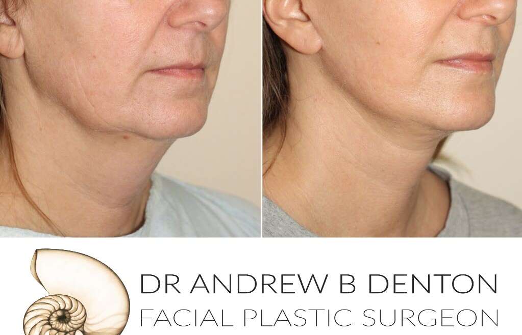 The Cost of Facelift Surgery in Vancouver: Understanding the Factors Involved