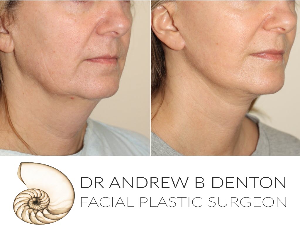 Facelift surgery before and after photos of a female middle-aged patient