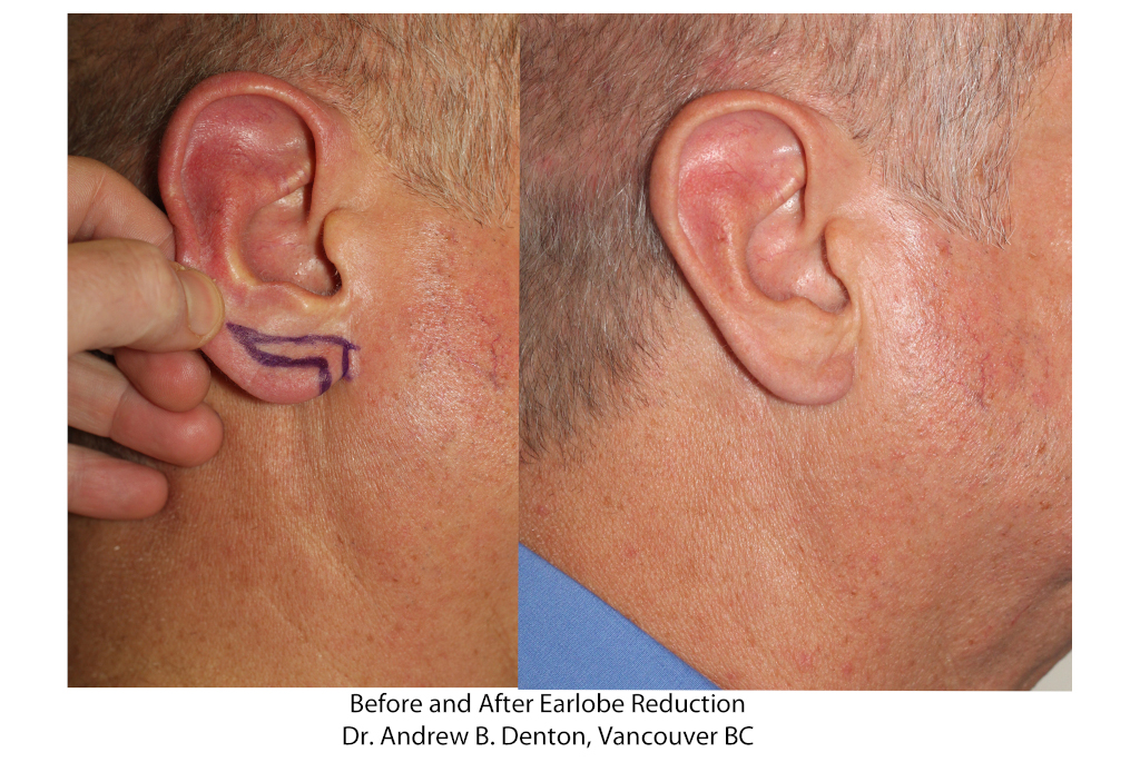 Dr. Denton Otoplasty before and after - ear lobe repair