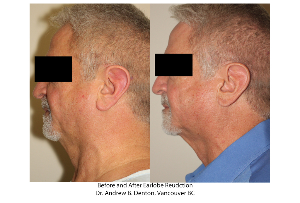 Dr. Denton Otoplasty before and after - ear lobe repair