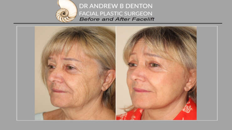 Facelift Recovery: Tips for a Speedy and Smooth Healing Process