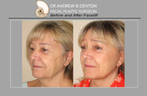 Facelift before and after photos of a mature female. Surgery performed by Dr Denton