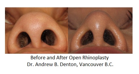 Nostril or Alar Base narrowing - rhinoplasty Dr Denton Vancouver BC