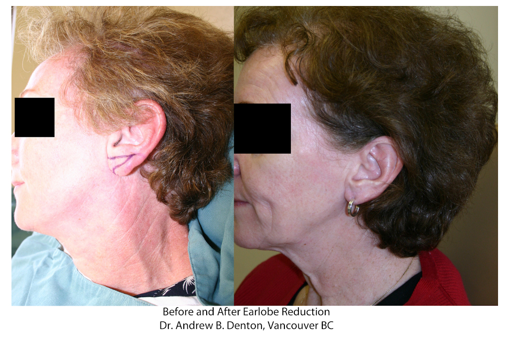 Dr. Denton Otoplasty before and after - ear lobe repair