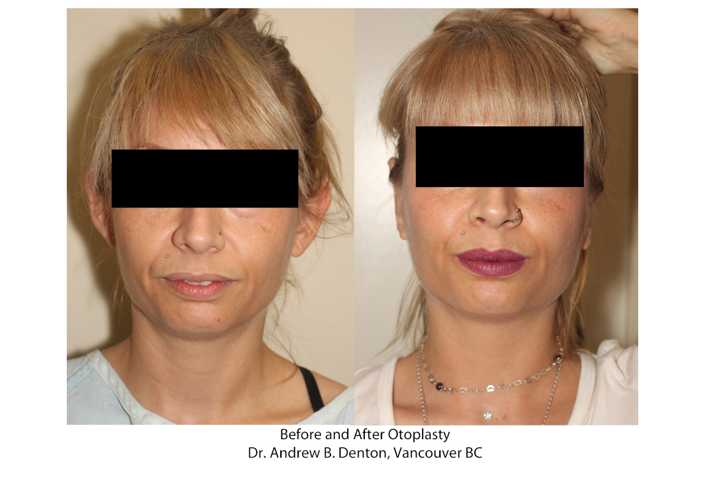 Dr. Denton Otoplasty before and after - ear lobe repair