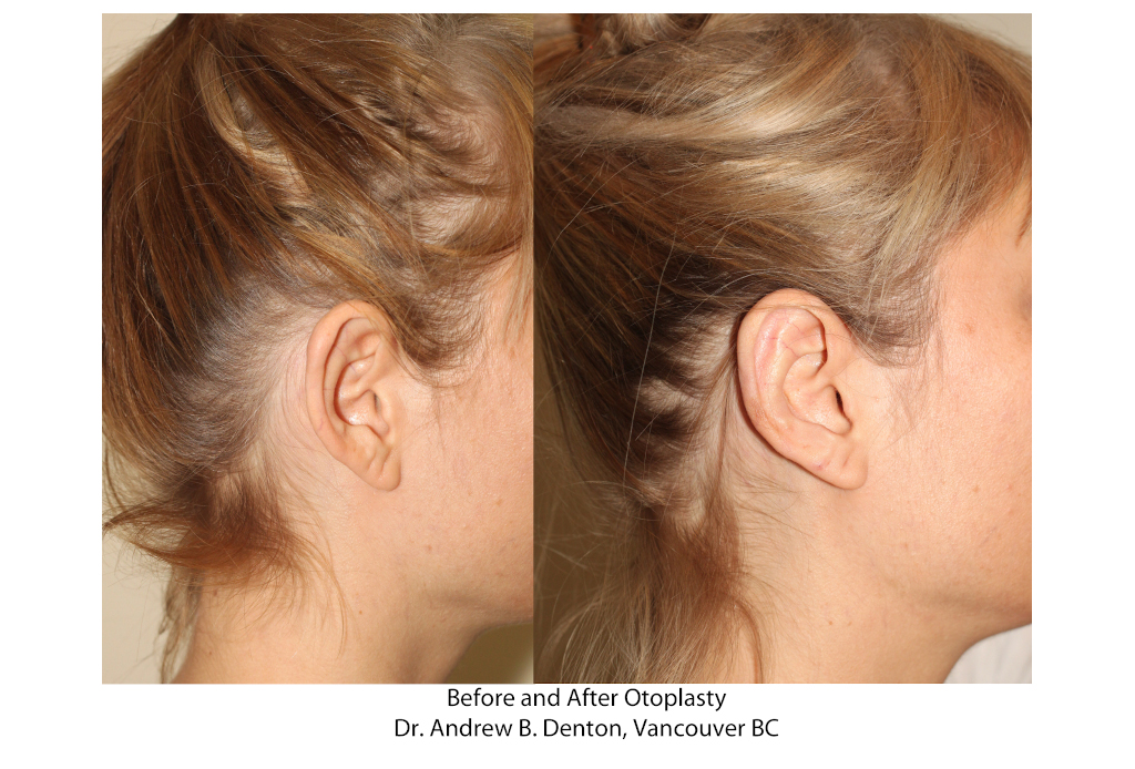 Dr. Denton Otoplasty before and after - ear lobe repair