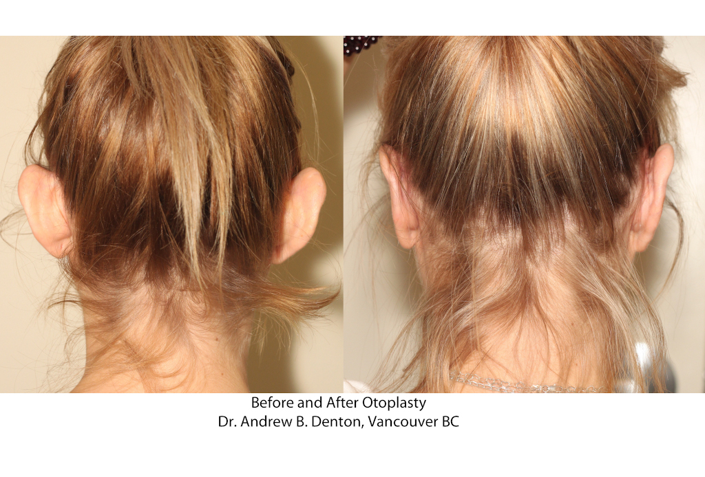 Dr. Denton Otoplasty before and after - ear lobe repair