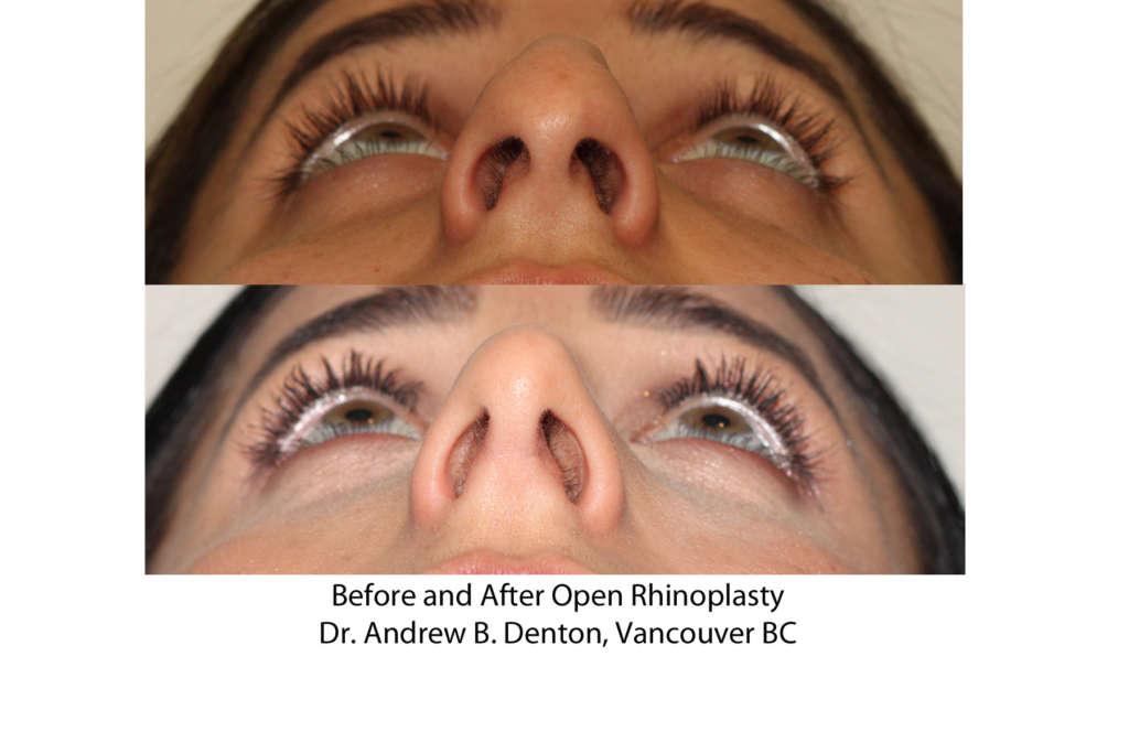 Alar Base Narrowing – Nostril Narrowing - Dr. Denton