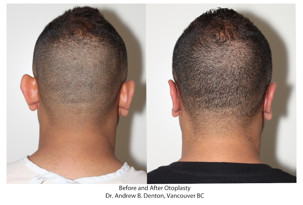 Dr. Denton Otoplasty before and after - ear lobe repair