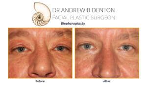 blepharoplasty before and after of a male patient in Vancouver, BC