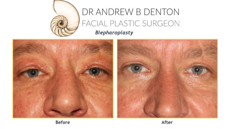 Choosing the Right Blepharoplasty Surgeon in Vancouver: Factors to Consider