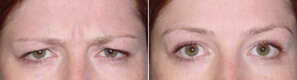 before and after Botox injection treatment around the eyes