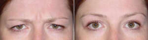 before and after Botox injection treatment around the eyes