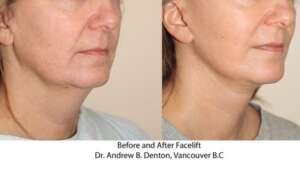 Facelift surgery before and after photos of a female middle-aged patient