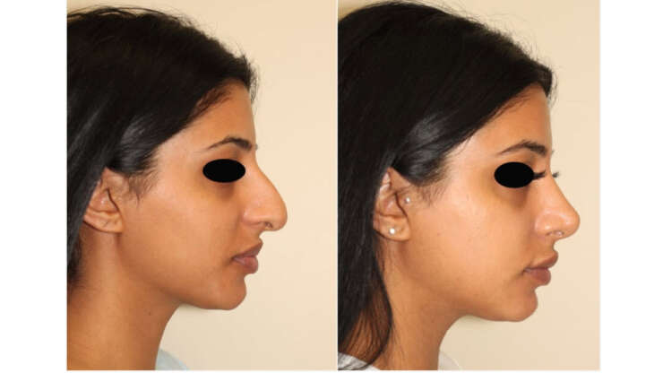 Things You Should Know About Rhinoplasty Surgery: Expert Advice from a Vancouver Rhinoplasty Specialist