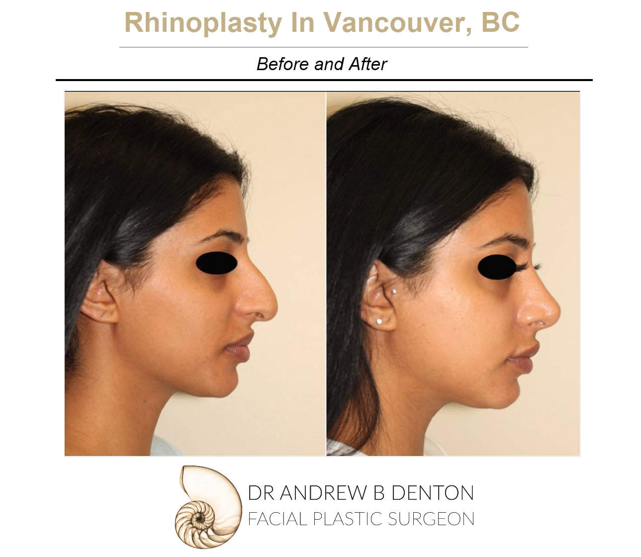 Things You Should Know About Rhinoplasty Surgery- Dr. Denton