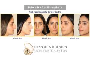 Before and After photos of rhinoplasty recovery of a young female patient