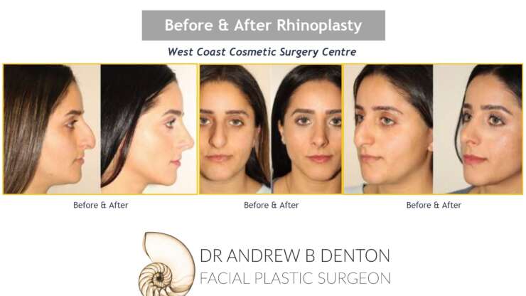 How Long is Rhinoplasty Recovery?