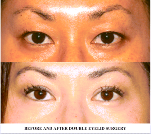 Asian blepharoplasty or eyelid surgery of young female before/after