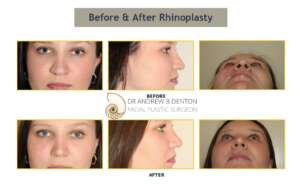 Rhinoplasty Surgery Before and After photos of a young female