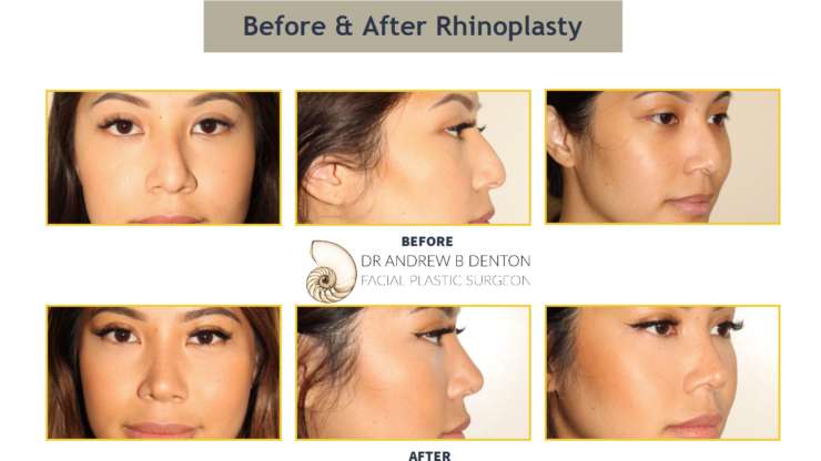 Important Do’s and Don’ts After Rhinoplasty Surgery