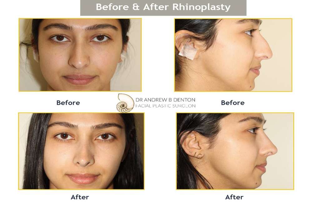 Frequently Asked Questions (FAQs) About Rhinoplasty