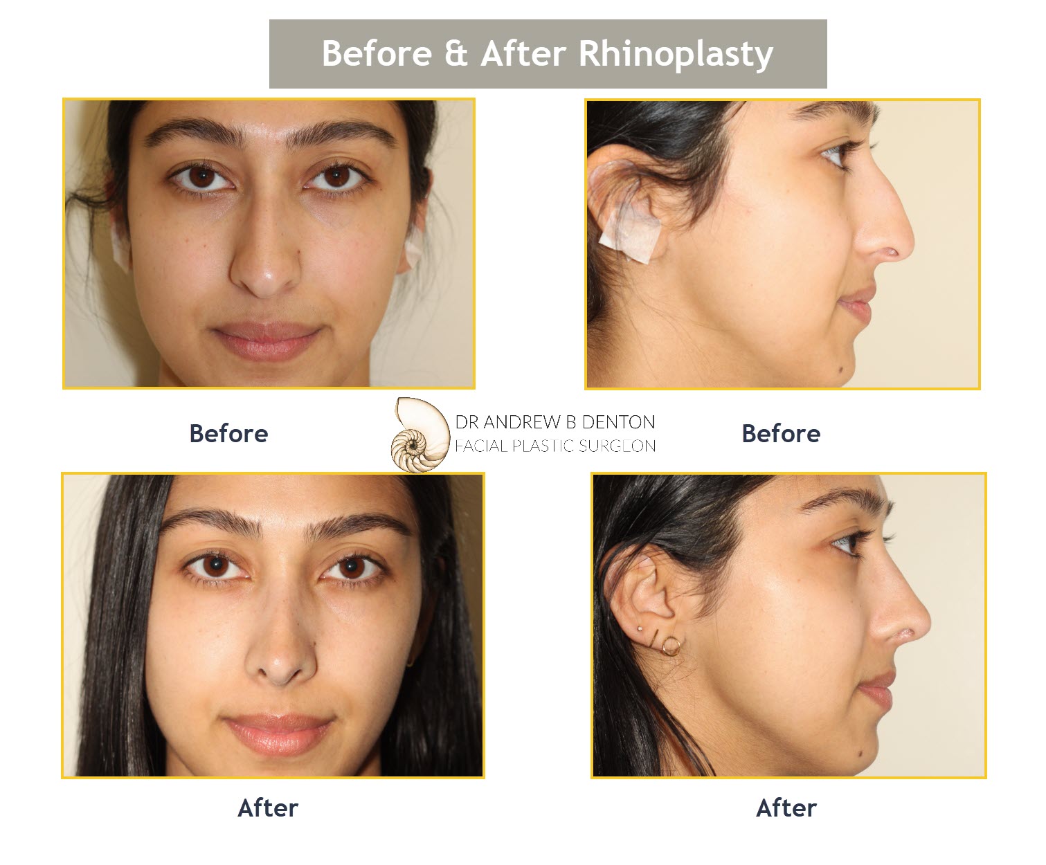 Before and after photos of a rhinoplasty procedure of a young woman. The Rhinoplasty was performed by Dr. Denton at his Vancouver clinic