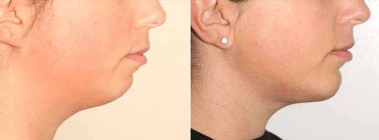 CONSIDERING FACIAL IMPLANT SURGERY IN VANCOUVER?
