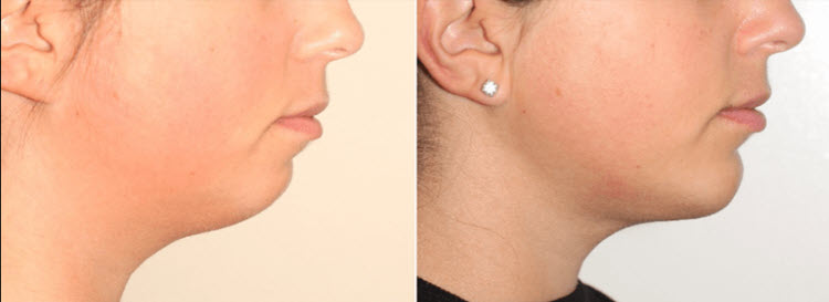 CONSIDERING FACIAL IMPLANT SURGERY IN VANCOUVER?