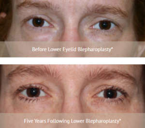 Eyelid lift or lower blepharoplasty before/after of mature woman
