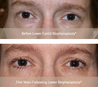 Are All Blepharoplasty or Eyelid Surgical Procedures the Same?