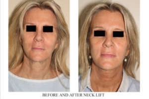 Neck Lift Before - After