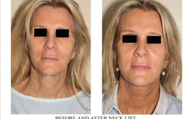 Rejuvenate Your Appearance with a Neck Lift
