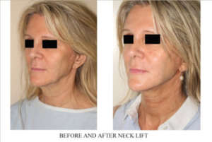 Neck lift Before - After