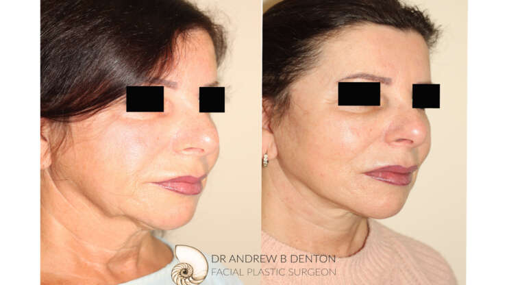 Is a Surgical Facelift Right for You?