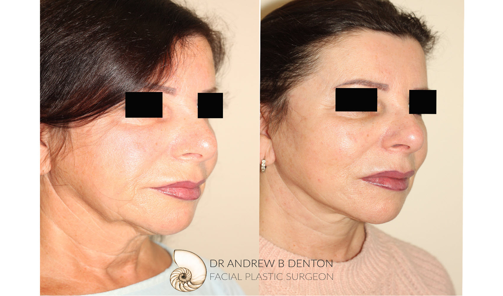 Before and after photos of a woman who has undergone a surgical facelift