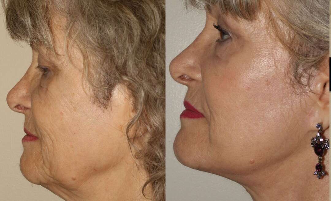 Your Guide to Facial Rejuvenation Options in Vancouver