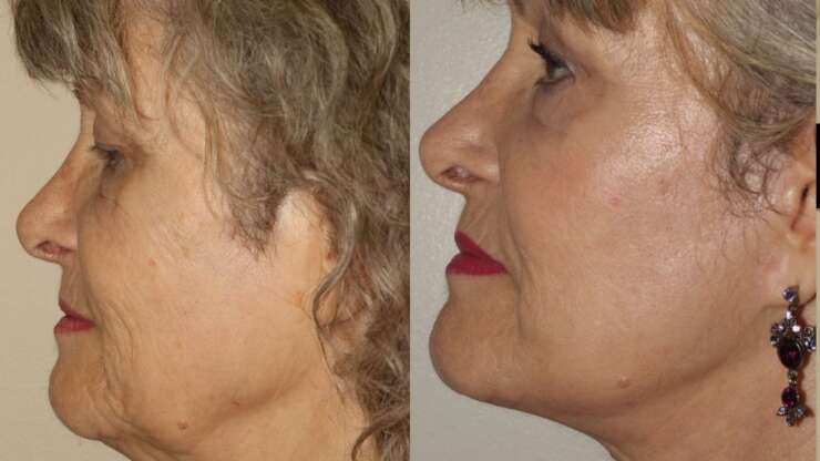 Your Guide to Facial Rejuvenation Options in Vancouver