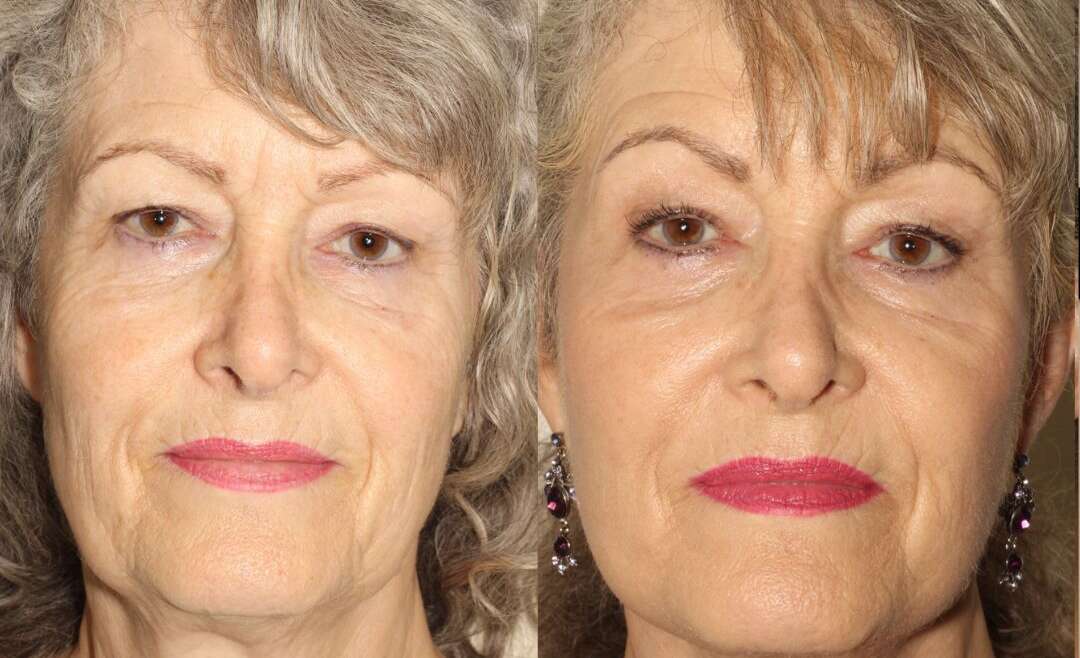 Facelift, Neck Lift, Upper Blepharoplasty and Laser Resurfacing (Facelift Vancouver)